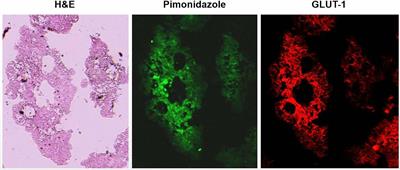 Visualization of hypoxia in cancer cells from effusions in animals and cancer patients